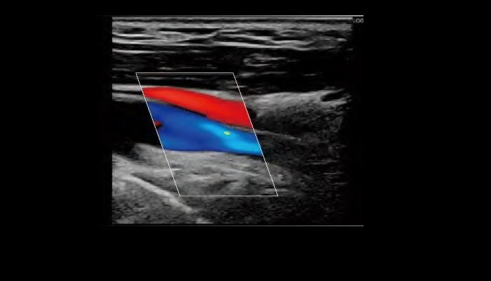 頸部エコー