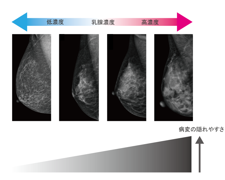 乳腺濃度画像