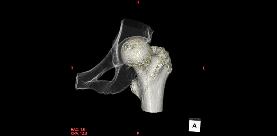 CT３D画像